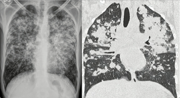 
Afectación pulmonar por sarcoma de Kaposi
