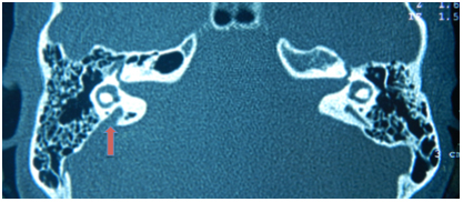Tomografía axial computarizada de oído. Se
observa dilatación anormal de acueducto vestibular derecho