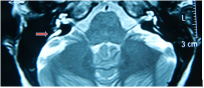 Resonancia magnética nuclear de oído con evidencia
de imagen hiperintensa correspondiente a conducto endolinfático
dentro del acueducto vestibular dilatado derecho