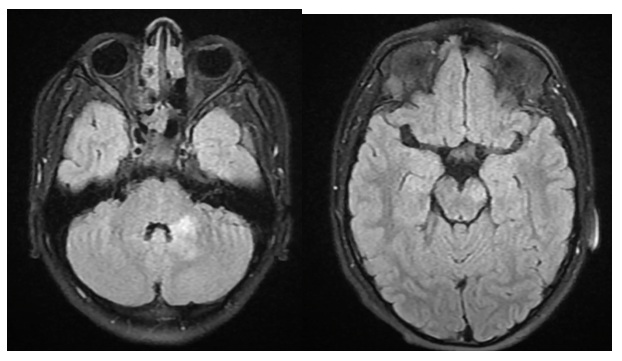 Resonancia magnética nuclear cerebral
con hiperseñales irregulares mal definidas en el pedúnculo cerebeloso medio del lado
izquierdo, así como en el pie del pedúnculo cerebral del mismo lado, con realce
de manera difusa heterogénea lineal e irregular con el medio de contraste, sin modificarse
en las secuencias de la difusión, de naturaleza más probablemente desmielinizante