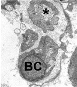 Pequeños brotes axonales regenerativos (asterisco) y células de Büngner adyacentes
como componentes tisulares típicos de un nervio periférico lesionado