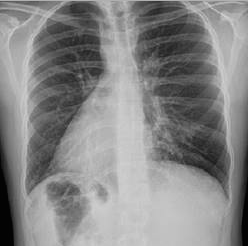 Radiografía de tórax con dextrocardia, silueta hepática en el hipocrondrio izquierdo,
sin consolidaciones ni derrame pleural