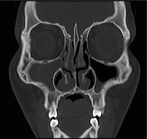 Tomografía axial computarizada de senos paranasales. Sinusitis de seno maxilar y
celdillas etmoidales derechos
