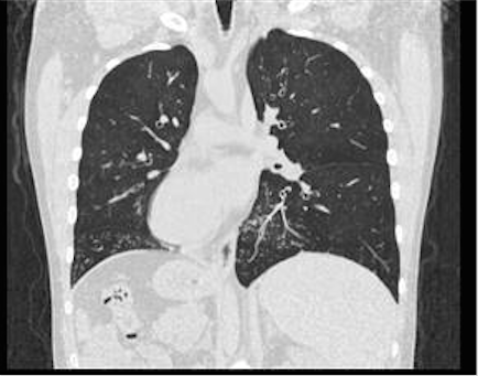 Tomografía axial computarizada de alta resolución de tórax con bronquiectasias y
situs inversus totalis
