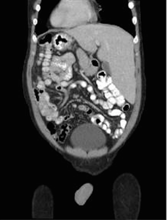 Tomografía axial computarizada de abdomen con evidencia de situs inversus totalis
