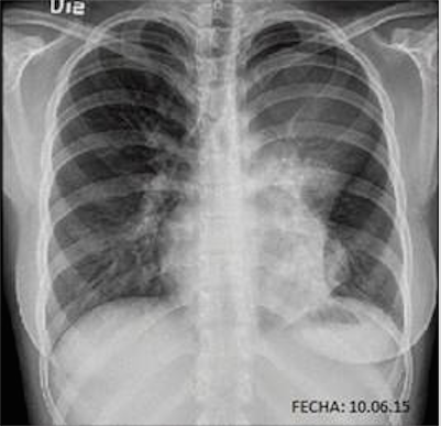 Radiografía de tórax con evidencia de imagen radiopaca
en el vértice izquierdo