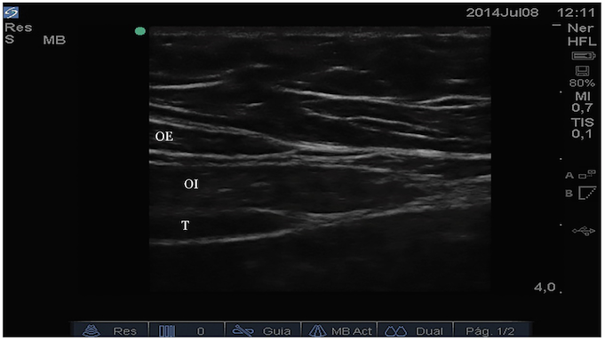 
Convergencia de fascias de oblicuo externo (OE), oblicuo interno (OI) y transverso
T) en el borde lateral del recto abdominal (línea semilunar)
