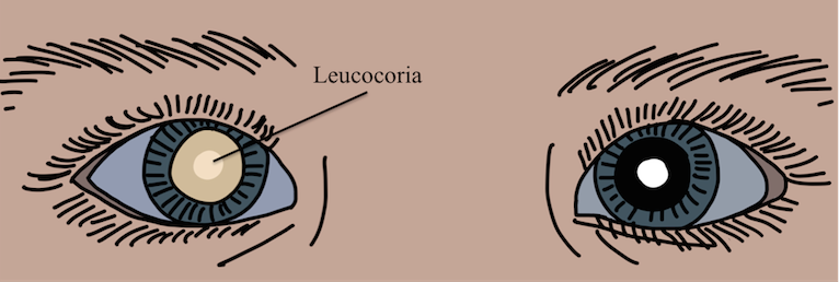 
Ausencia de
reflejo rojo (debido a leucocoria) de ojo izquierdo en
paciente con catarata congénita
