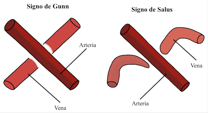 
Signo de Gunn y signo de Salus
