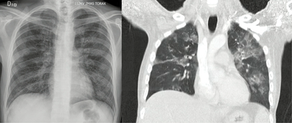 
Compromiso pulmonar por Pneumocystis
jirovecii

