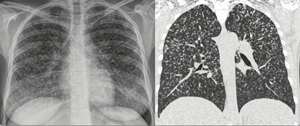 
Afectación
pulmonar por tuberculosis
