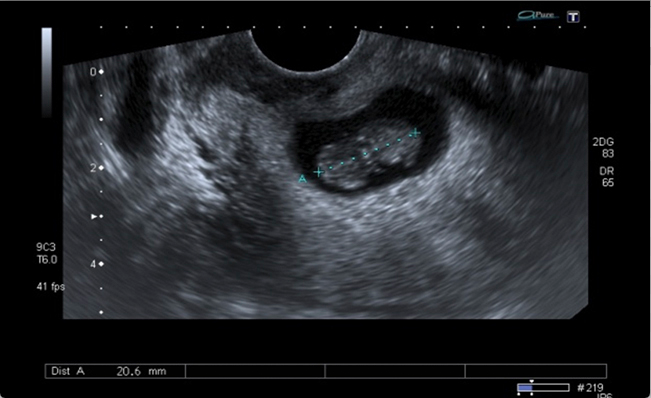 
Polo embrionario de 20,6 mm sin actividad
cardiaca
