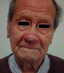 Lesión en punta nasal de aproximadamente 3 cm, antes
del tratamiento