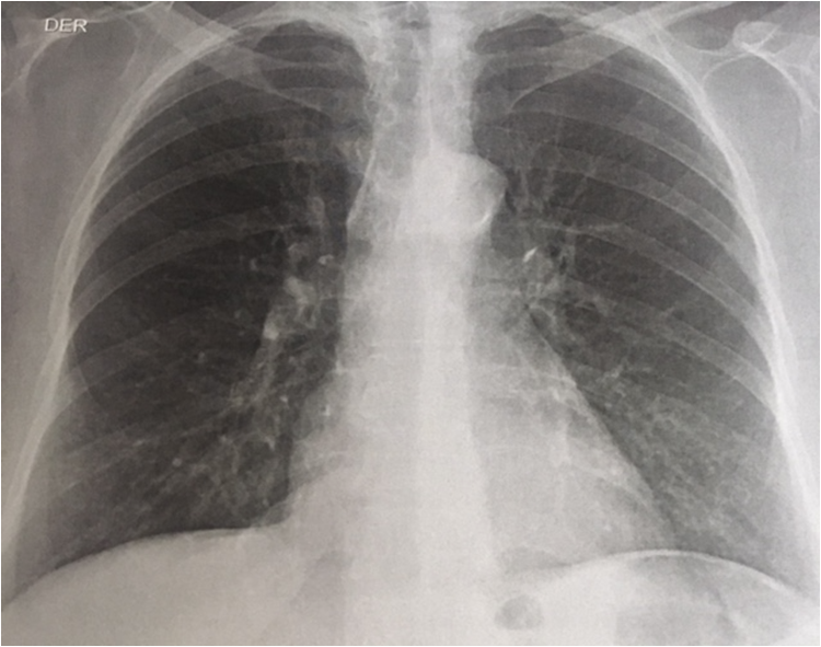 
Radiografía de tórax del paciente, proyección posteroanterior que evidencia infiltrados
micronodulares parabronquiales y signos de hipertensión pulmonar, entre otros hallazgos
como atelectasia del lóbulo inferior derecho y elongación de la aorta
