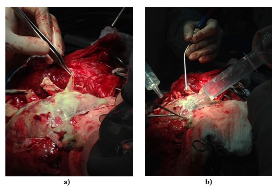 
a) Visualización del empiema posterior a durotomía con membranas
purulentas, rígidas, gruesas y posterior. b) Lavado
