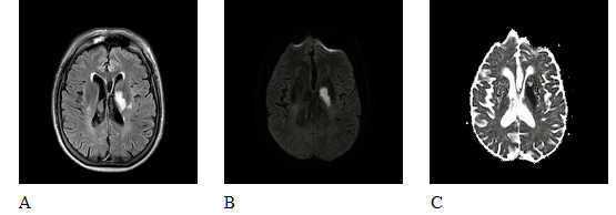 Imágenes de IRM cerebral. A) FLAIR. Lesión hiperintensa gangliobasal izquierda. B) DWI. Lesión hiperintensa con
restricción de señal gangliobasal izquierda. C) ADC. Imagen de baja señal en mapa
de ADC gangliobasal izquierda que se corresponde con localización
de imágenes A y B