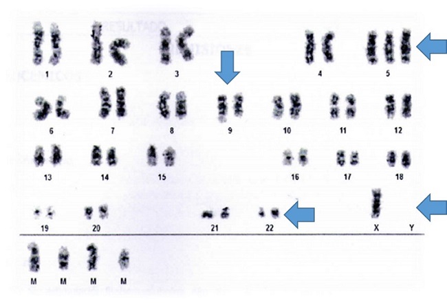 Resultado de cariotipo:
50, X, −Y, +5, t(9;22) (q34;q11,2), +2mar2, +mar3 [5]/46, XY [15]. Translocación
(9;22) (q34;q11) con BCR-ABL y cromosoma filadelfia, presente en la médula ósea
del paciente