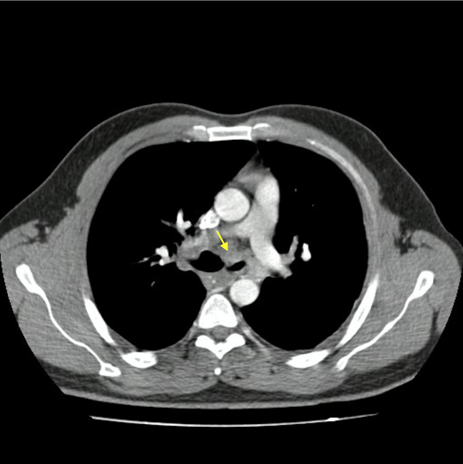 Tomografía axial computarizada de tórax (ventana de
mediastino) que muestra masa subcarinal que afecta el
bronquio fuente izquierdo (flecha amarilla)