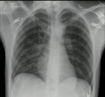 Radiografía de tórax.