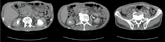 Tomografía de abdomen contrastada. De izquierda a derecha (ver círculos) dilatación pielocalicial izquierda, estenosis del uréter sin paso de medio de contraste y dilatación del uréter inferior, respectivamente