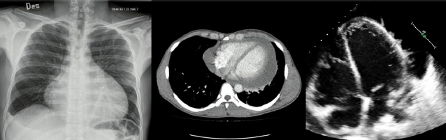 Radiografía de tórax (izquierda) con signo de botella de agua. En el centro, tomografía de tórax con contraste que evidencia derrame pericárdico con grosor máximo de 25 mm. Ecocardiograma transtorácico (derecha) que evidencia pericardio hiperrefringente, derrame pericárdico global con detritus celulares y fibrina en su interior