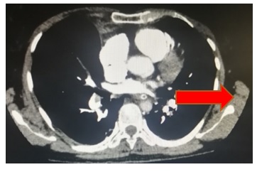 Tomografía contrastada de tórax con protocolo para arterias pulmonares. Imagen del defecto de llenado de baja atenuación en la arteria pulmonar derecha