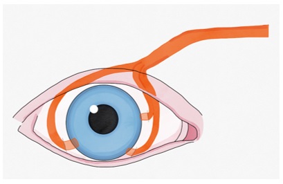 En la técnica de neurotización corneal los nervios supraorbitario o supratroclear se transfieren al área contralateral o ipsilateral en la superficie ocular y se fijan debajo de la conjuntiva