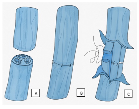 Tipos de neurorrafia primaria: a) lesión nerviosa, b) neurorrafia epineural, c) neurorrafia perineural (interfascicular)