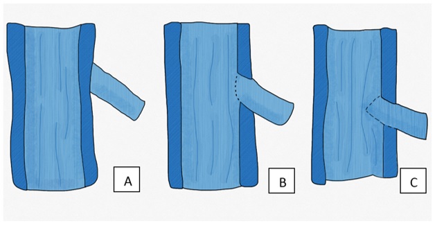 Diferentes formas de realizar anastomosis término-laterales. a) Epineuro intacto. b) Ventana de epineuro. c) Neurectomía parcial