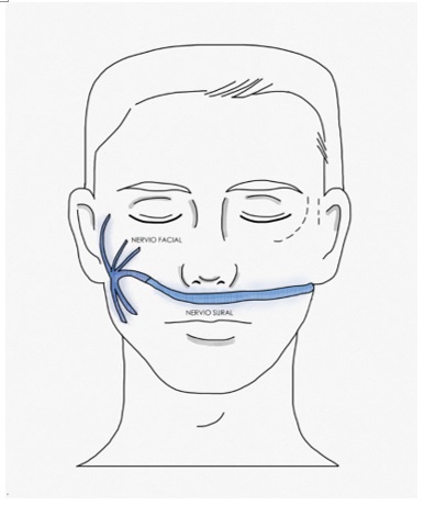 Injerto de nervio colocado entre ramas del nervio facial sano a ramas del nervio facial comprometido, con el fin de suministrar axones sanos al nervio facial lesionado