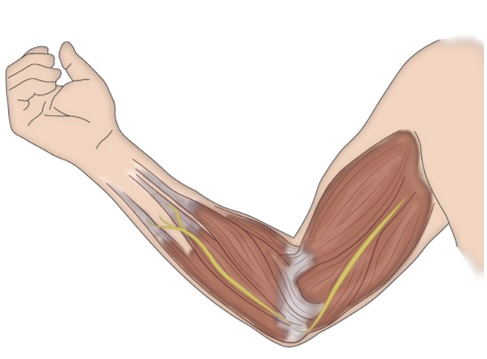 Neurotización muscular directa inserción de cabo distal de un nervio sano en un músculo denervado