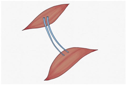 Neurotización músculonerviomúsculo Colocación de un injerto nervioso que sirva de puente para que brotes axonales de un músculo sano lleguen al músculo denervado