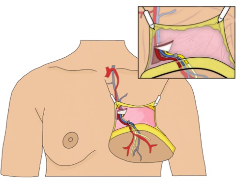 Neurotización cutánea en reconstrucción de seno al realizar neurorrafia entre un nervio cutáneo incluido en el colgajo transferido y un nervio receptor intercostal