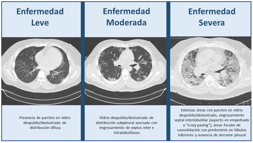 Hallazgos tomográficos según la clasificación de gravedad de la enfermedad COVID19 (17)