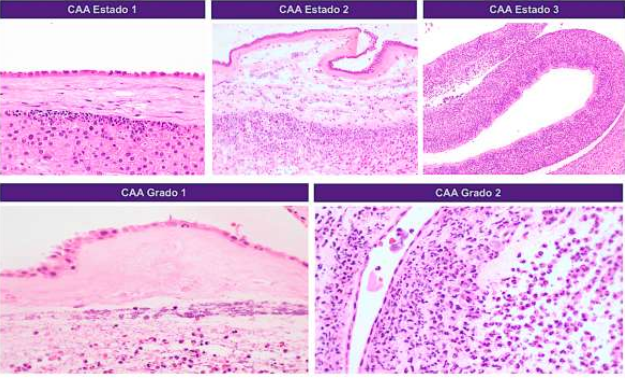 CAA estadio 1: subcorionitis aguda, con presencia de infiltrado en banda, compuesto por neutrófilos debajo de la placa coriónica. CAA estadio 2: corioamnionitis aguda. Se observa infiltrado inflamatorio de tipo neutrofílico en el corion y en el amnios. CAA estadio 3: corioamnionitis necrosante, donde se identifica un compromiso completo del corion y del amnios, incluyendo necrosis del amnios. Grado 1: sin formación de conglomerados de células inflamatorias agudas de tipo polimorfo-nuclear neutrófilo. Grado 2: presencia de abscesos.