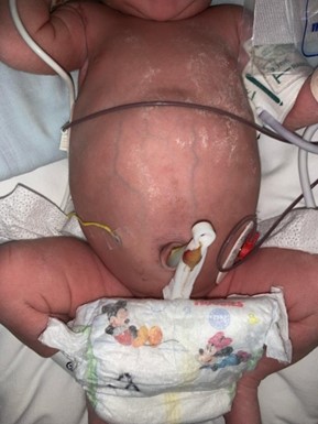 Distensión abdominal evidenciada al examen físico de la recién nacida