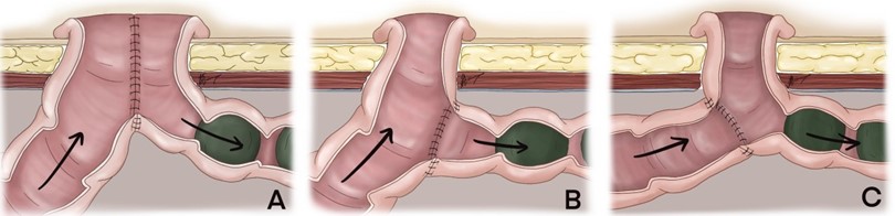 Enterostomía latero-laterales de Mikulicz; B) Anastomosis término-lateral distal de Bishop y Coops; C) Anastomosis en Y de Roux (término-lateral) con anastomosis en “chimenea” proximal y enterostomía con la terminación del intestino proximal de Santulli.