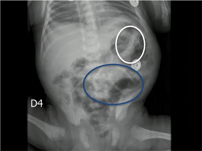 Radiografía AP de abdomen portátil en la que se identifica leve distensión de algunas asas intestinales (elipse azul), con signos de neumatosis en el hipocondrio izquierdo (elipse blanca)