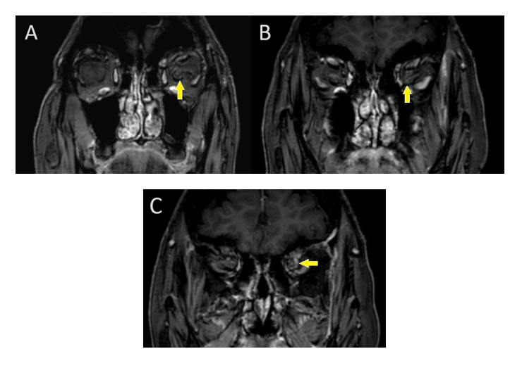 RMN cerebral con contraste con gadolinio. A), B), C) Cortes coronales con realce linear dural de un pequeño segmento inmediatamente retrobulbar del nervio óptico izquierdo (flechas)