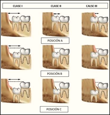 Pell and Gregory Classification for Lower Third Molars (5,16-17)