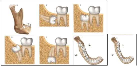 Winter's classification for lower third molars: A: mesioangular, B: horizontal, C: vertical, D: distoangular, E: inverted, F: vestibuloversion, G: linguoversion (15,16-17)