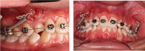 Activation of Chains on Teeth 13 and 23, Case 2