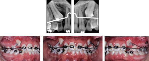 Orthodontic traction of a retained upper canine with Edgewise