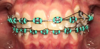 Adaptation of Nickel-Titanium Overarches and Elastic Wire on Tooth 23, Case 1