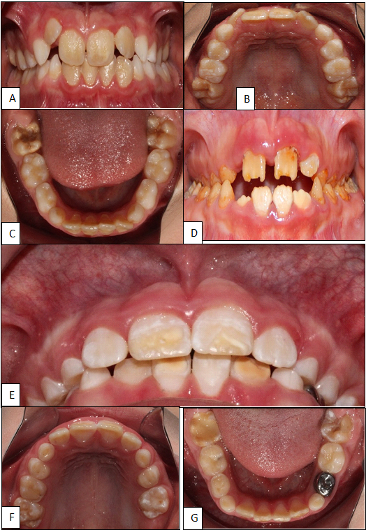 Intraoral Photographs of Individuals with IMH and AI*