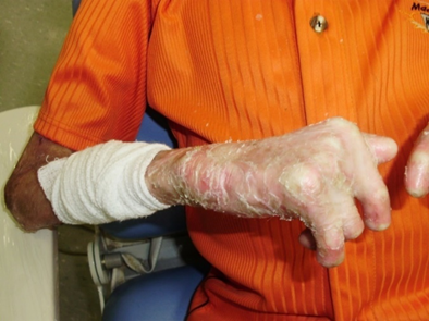 Bullous lesions in the upper limb with arachnoid-shaped hands and motor difficulties