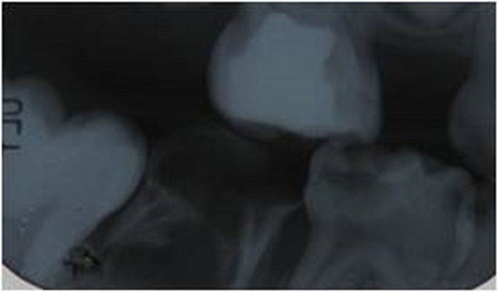 Imagen radiográfica donde se corrobora la lesión de furca
en el segundo molar inferior izquierdo