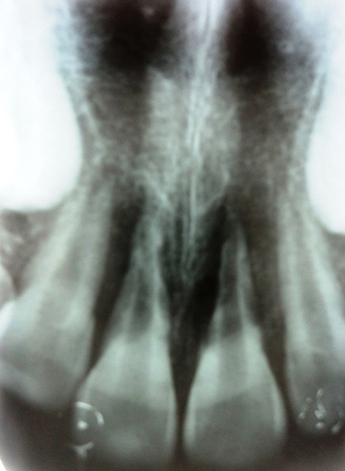 Radiografía de la primera cita, 33 días después del trauma. Se observan
las zonas de reabsorción en las superficies radiculares
externas de los dientes 11 y 21 con pérdida del espacio del ligamento periodontal