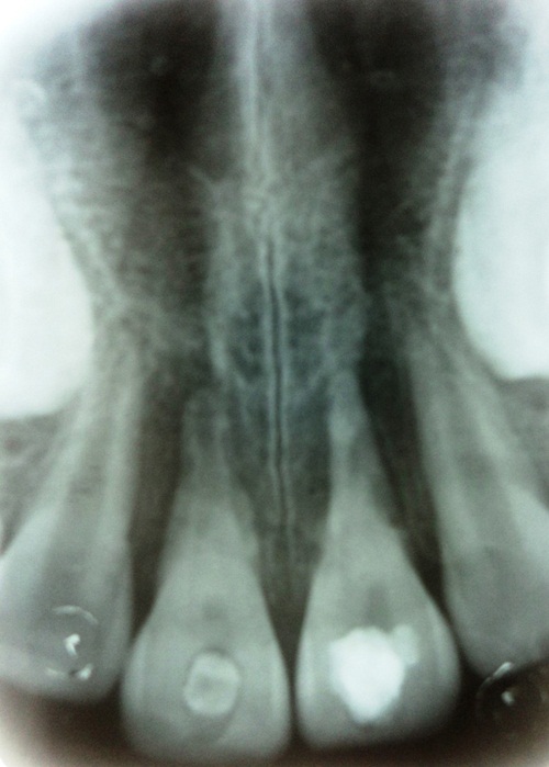 Radiografía postoperatoria de la cita inicial. Preparación de los dientes 11 y 21. Medicación intracanal con hidróxido de
calcio