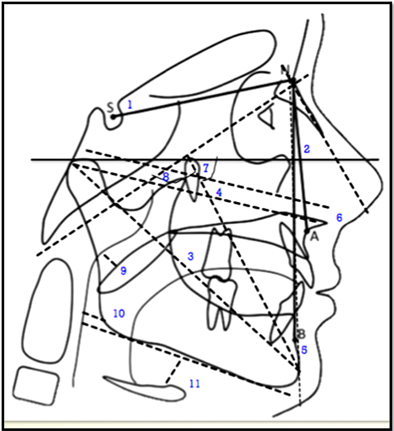 Puntos y planos cefalométricos utilizados en
el análisis de los niños en el estudio